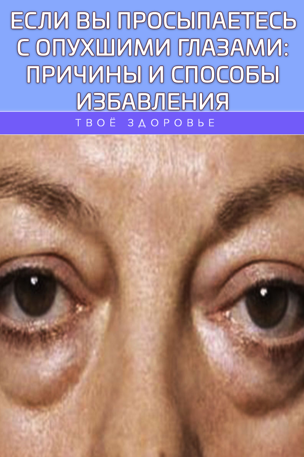 Если вы просыпаетесь с опухшими глазами: причины и способы избавления