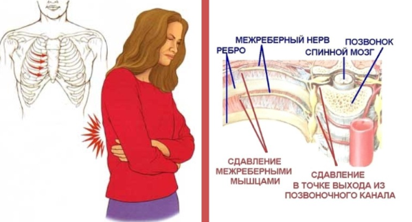 Боль при невралгии