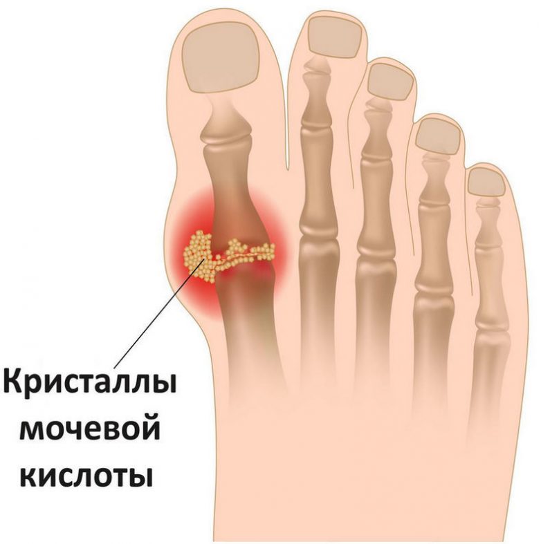 Что то можно и чего нельзя есть при подагре