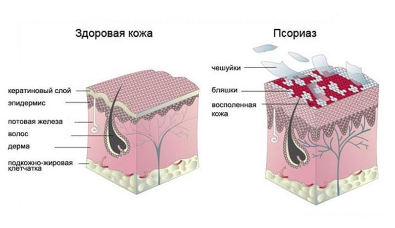 Всё, что нужно знать о псориазе