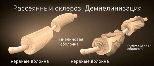 Рассеянный склероз: симптомы, лечение. Сколько с ним живут
