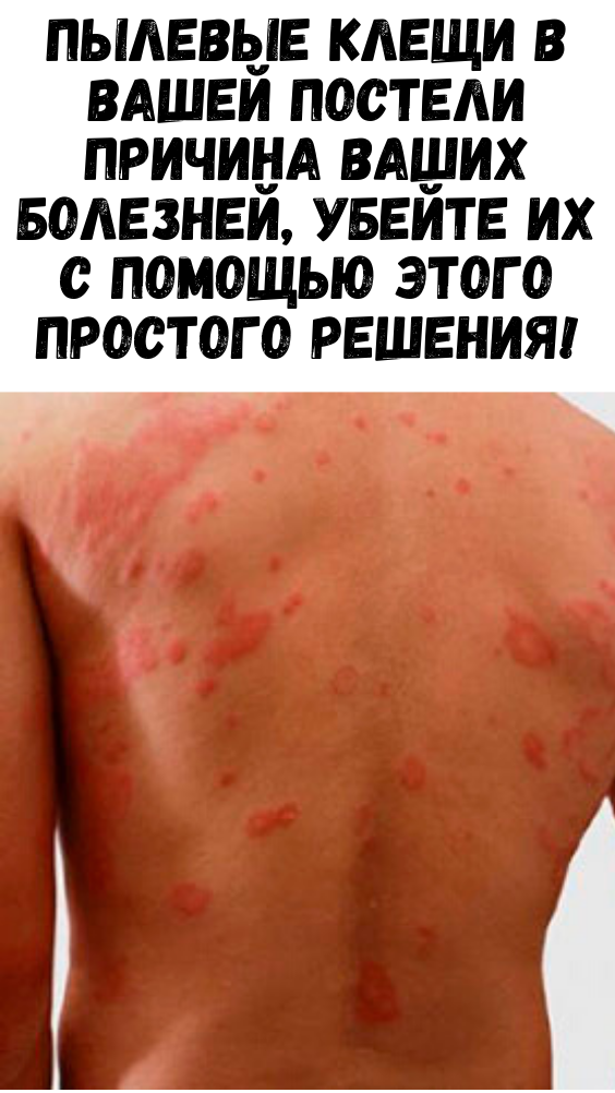Пылевые клещи в вашей постели причина ваших болезней, убейте их с помощью этого простого решения!