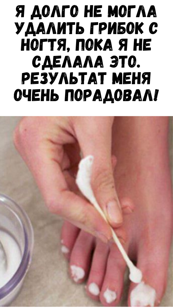 Я долго не могла удалить грибок с ногтя, пока я не сделала это. Результат меня очень порадовал!