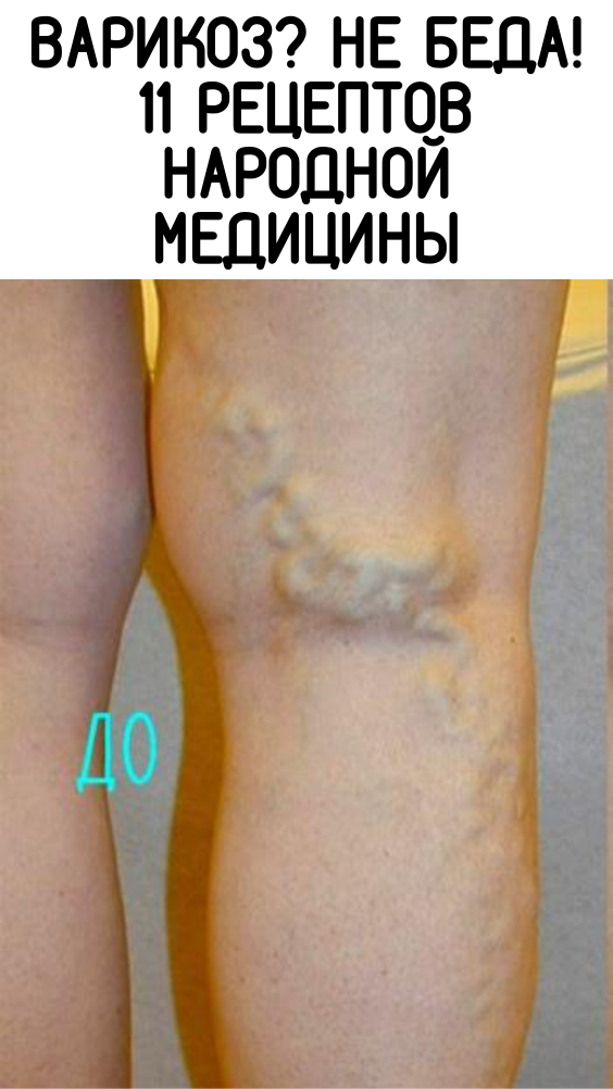 ВАРИКОЗ? НЕ БЕДА! 11 РЕЦЕПТОВ НАРОДНОЙ МЕДИЦИНЫ