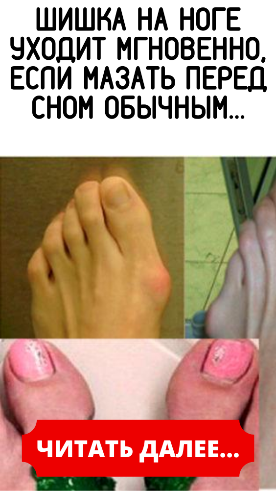 Шишка на ноге уходит мгновенно, если мазать перед сном обычным…