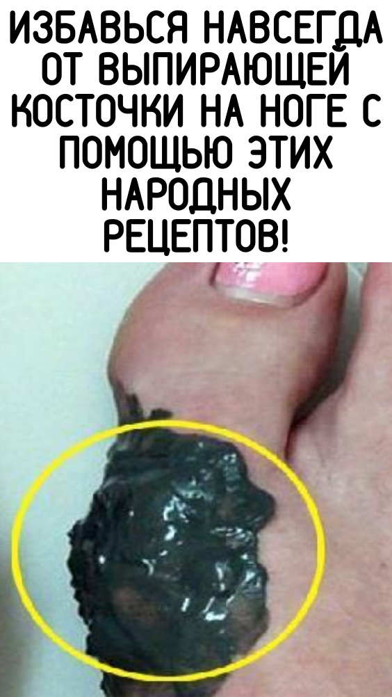 Избавься навсегда от выпирающей косточки на ноге с помощью этих народных рецептов!