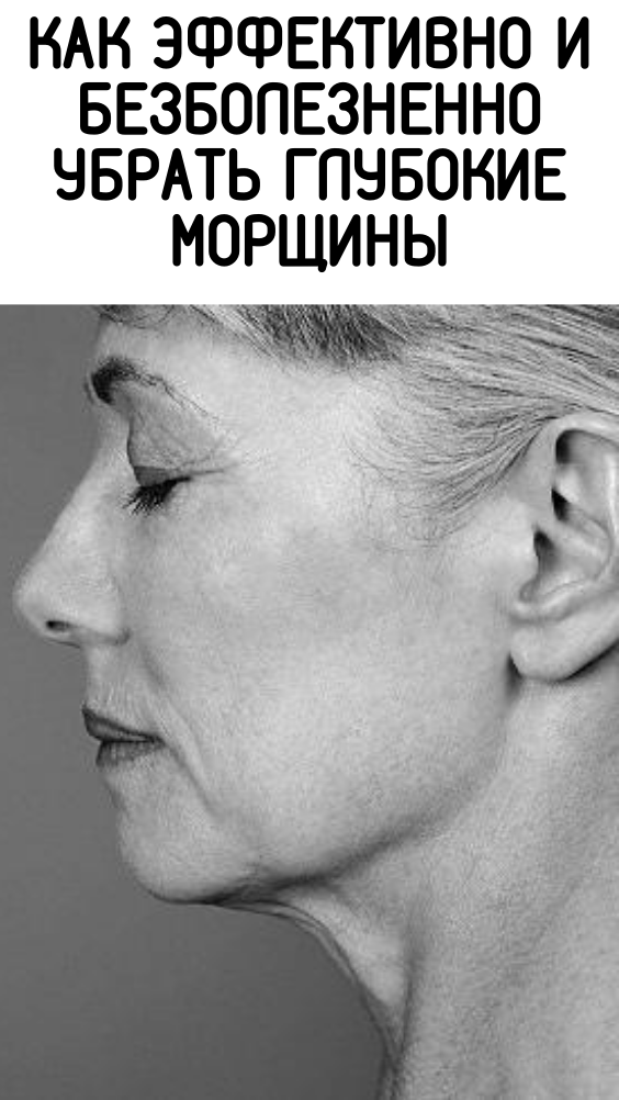 Как эффективно и безболезненно убрать глубокие морщины