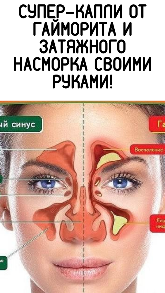 СУПЕР-КАПЛИ ОТ ГАЙМОРИТА И ЗАТЯЖНОГО НАСМОРКА СВОИМИ РУКАМИ!
