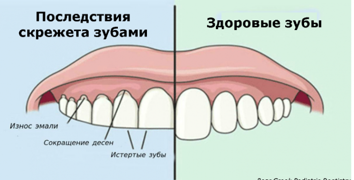 Если вы скрипите зубами по ночам, вот что это значит!