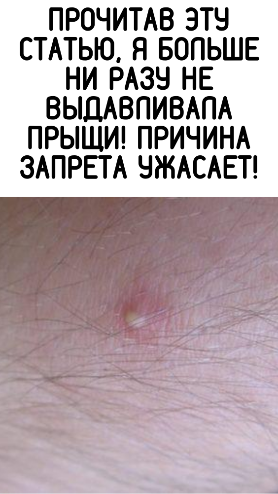 Прочитав эту статью, я больше ни разу не выдавливала прыщи! Причина запрета ужасает!