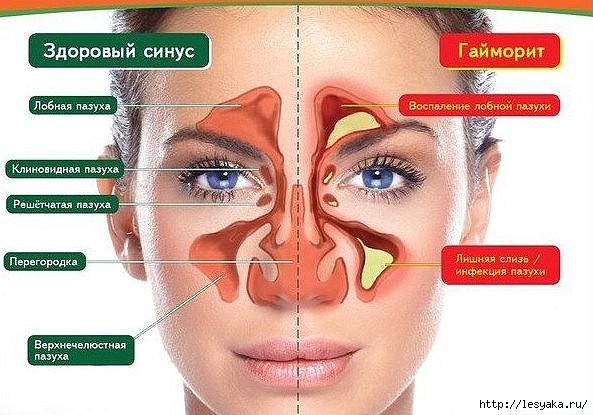 СУПЕР-КАПЛИ ОТ ГАЙМОРИТА И ЗАТЯЖНОГО НАСМОРКА СВОИМИ РУКАМИ!