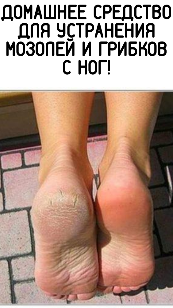 Домашнее средство для устранения мозолей и грибков с ног!