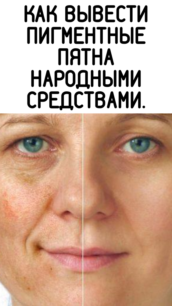 КАК ВЫВЕСТИ ПИГМЕНТНЫЕ ПЯТНА НАРОДНЫМИ СРЕДСТВАМИ.