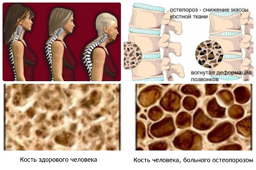 Рецепты лечения остеопороза