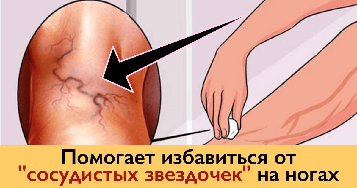 Избавляемся от «СОСУДИСТЫХ ЗВЕЗДОЧЕК» на ногах без операций и лекарств! Избавляемся от «СОСУДИСТЫХ ЗВЕЗДОЧЕК» на ногах без операций и лекарств!
