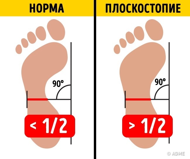 ВСЕГО 2 УПРАЖНЕНИЯ, И ПЛОСКОСТОПИЕ ВАС НЕ ПОБЕСПОКОИТ ВСЕГО 2 УПРАЖНЕНИЯ, И ПЛОСКОСТОПИЕ ВАС НЕ ПОБЕСПОКОИТ