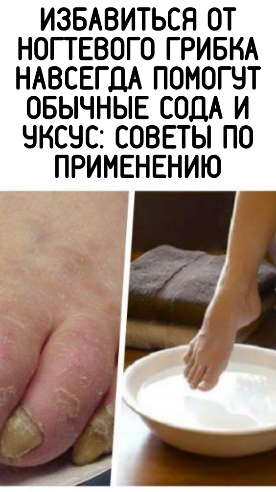 Избавиться от ногтевого грибка навсегда помогут обычные сода и уксус: советы по применению