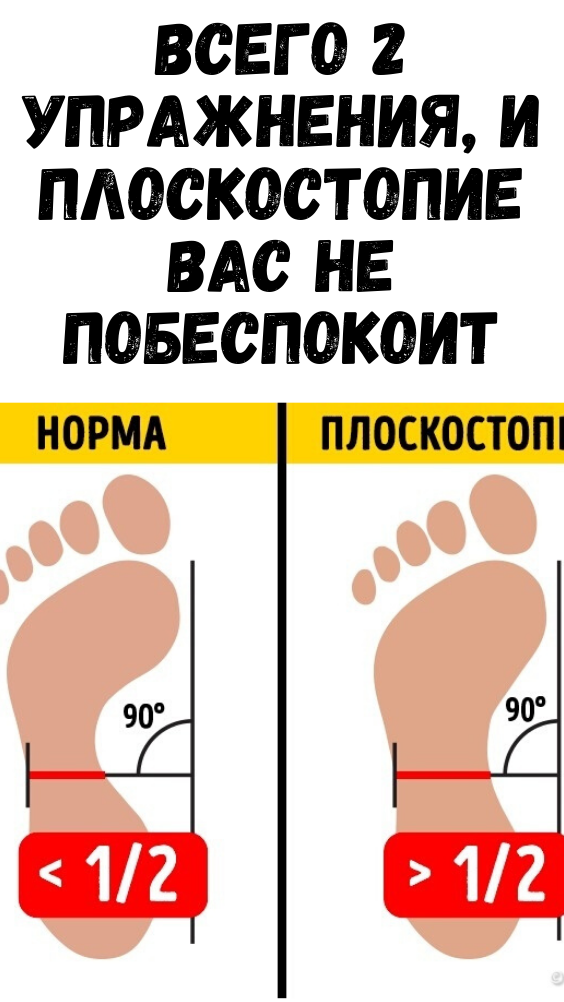 ВСЕГО 2 УПРАЖНЕНИЯ, И ПЛОСКОСТОПИЕ ВАС НЕ ПОБЕСПОКОИТ