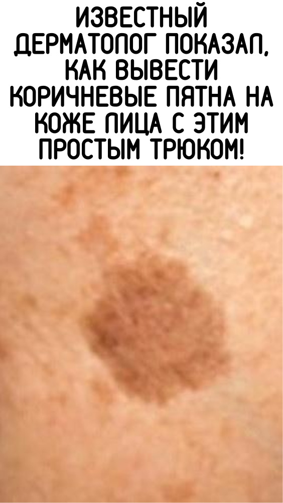 Известный дерматолог показал, как вывести коричневые пятна на коже лица с этим простым трюком!