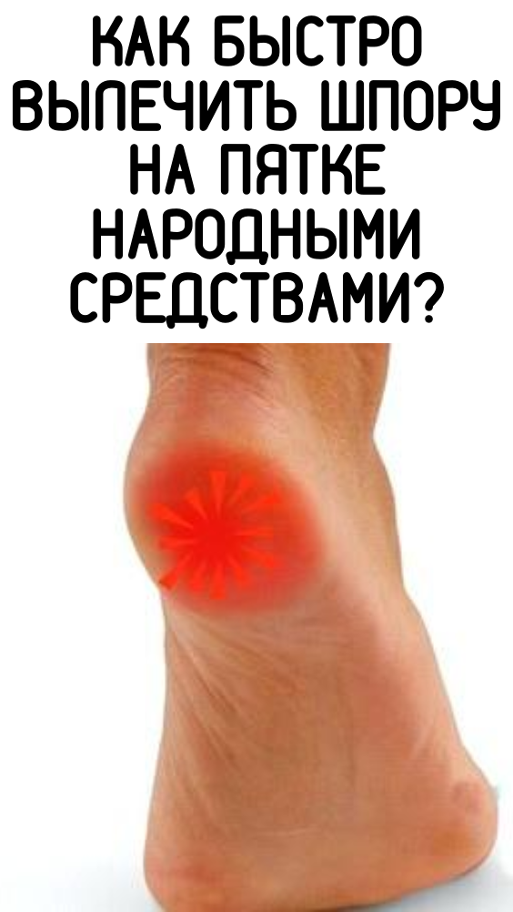 Как быстро вылечить шпору на пятке народными средствами?
