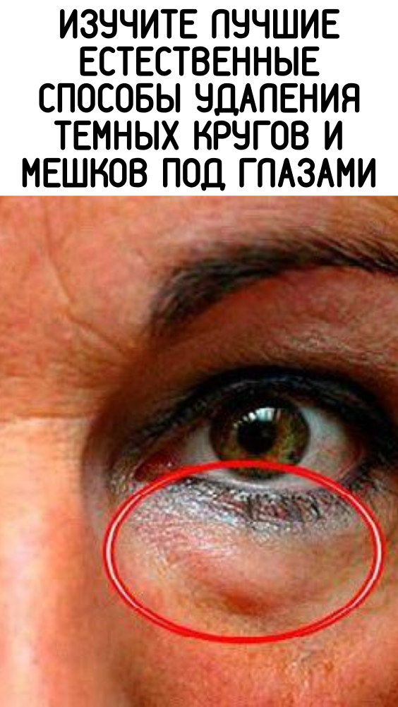 Изучите лучшие естественные способы удаления темных кругов и мешков под глазами
