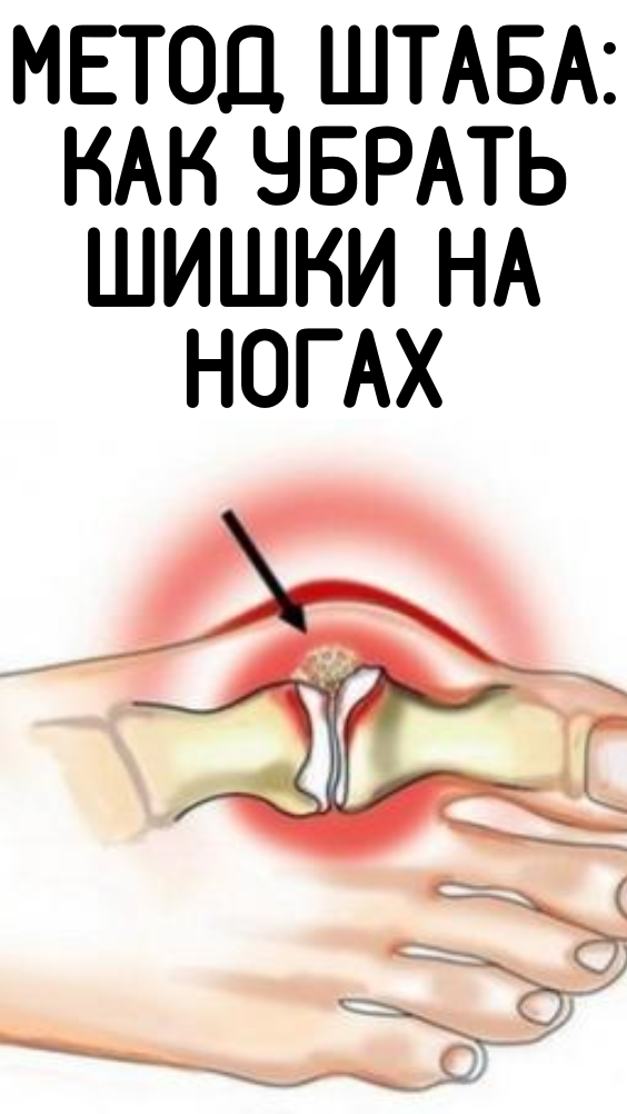 Метод Штаба: Как убрать шишки на ногах