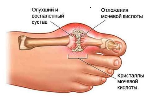 Лечение подагры народными средствами