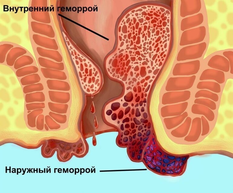 Симптомы и признаки геморроя
