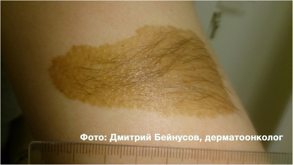 Опасные родинки: 3 правила для предупреждения меланомы Опасные родинки: 3 правила для предупреждения меланомы