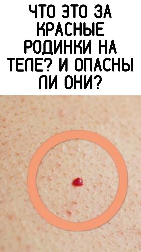 Что это за красные родинки на теле? И опасны ли они?