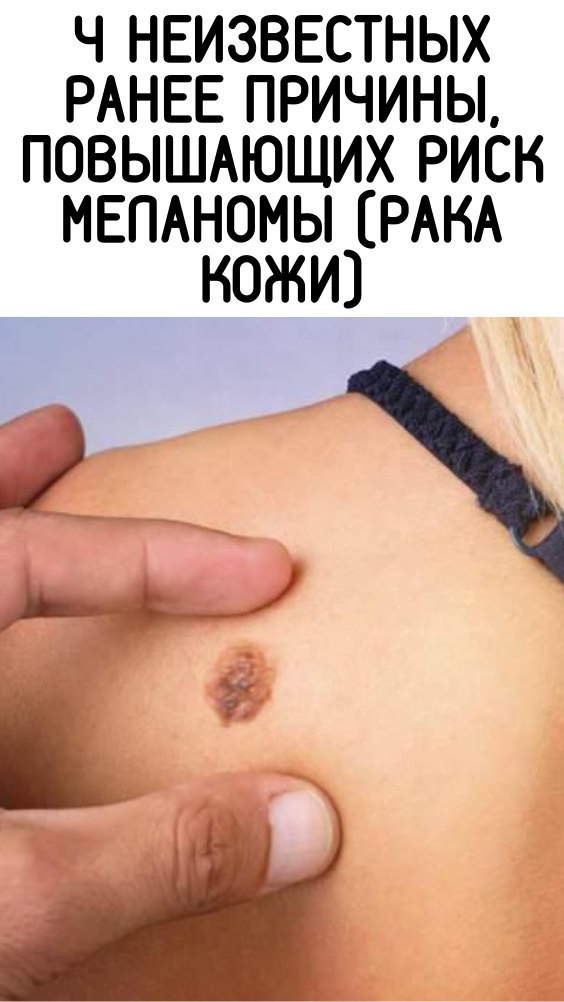 4 неизвестных ранее причины, повышающих риск меланомы (рака кожи)