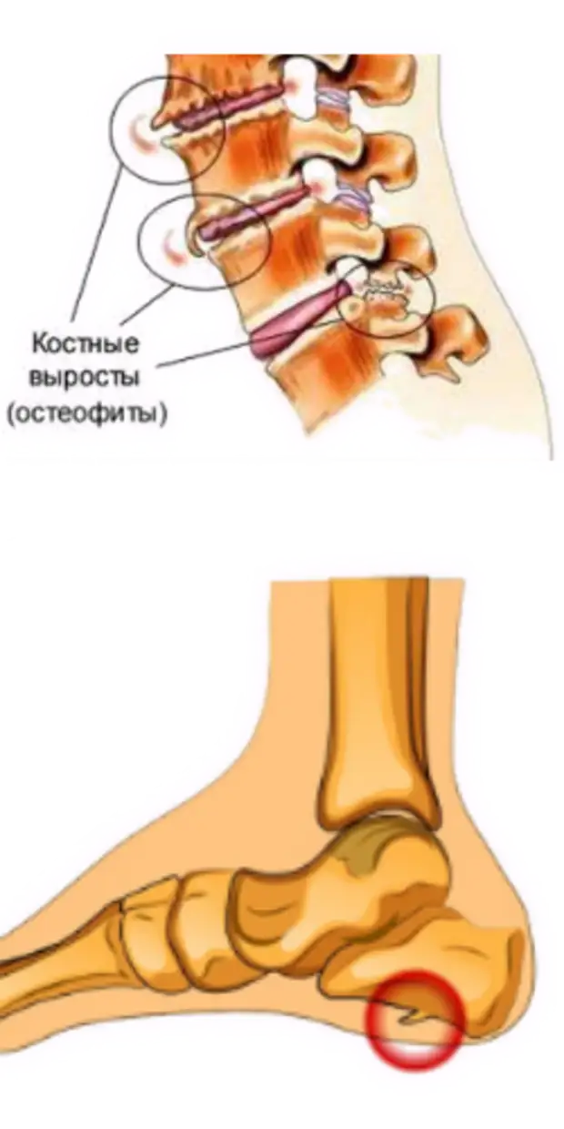 Пяточная шпора или плантарный фасциит
