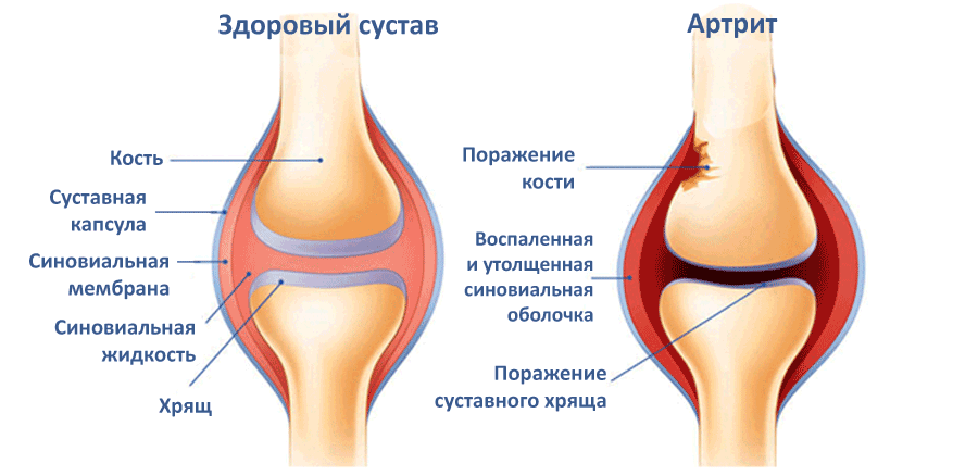 Что древняя индийская медицина говорит о воспалении суставов
