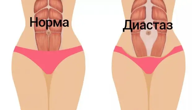 Причина ваших неудач в похудении может заключаться в диастазе!