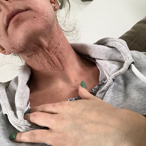 Женщина избавилась от ужасной экземы став вегетарианкой Женщина избавилась от ужасной экземы став вегетарианкой
