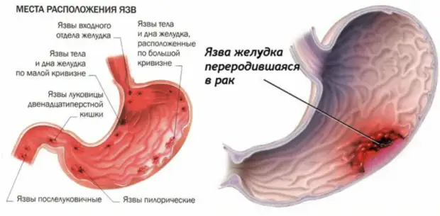 Первые признаки язвы желудка
