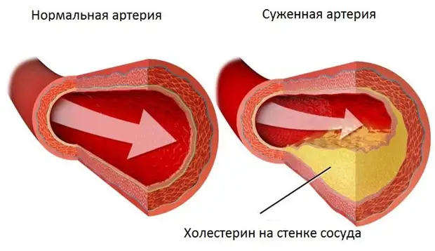 17 продуктов, снижающих холестерин, чтобы артерии были чистыми от налета