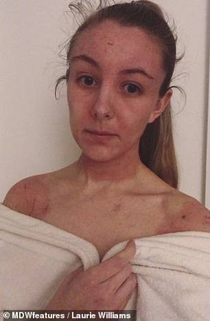 Женщина избавилась от ужасной экземы став вегетарианкой Женщина избавилась от ужасной экземы став вегетарианкой