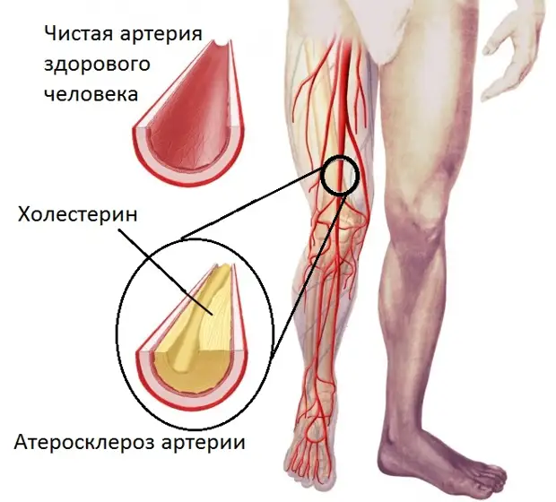 Лечение атеросклероза народными средствами