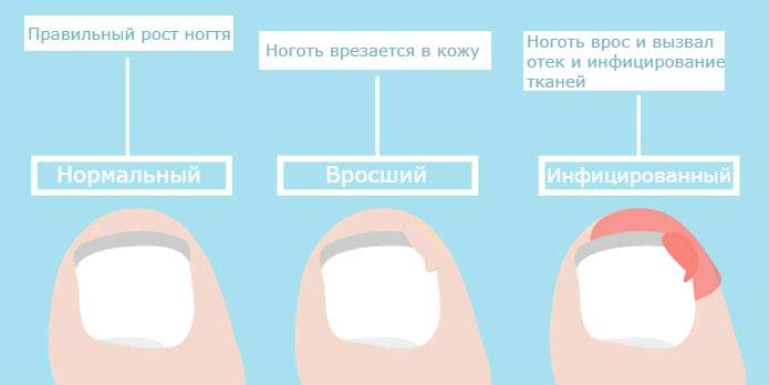 Вросший ноготь! Вот как от него избавиться без хирургии! Вросший ноготь! Вот как от него избавиться без хирургии!