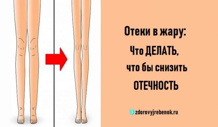 Отеки в жару: Что ДЕЛАТЬ, что бы снизить ОТЕЧНОСТЬ Отеки в жару: Что ДЕЛАТЬ, что бы снизить ОТЕЧНОСТЬ