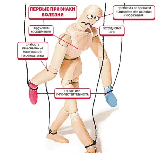 Как определить рассеянный склероз на ранней стадии