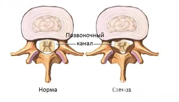 Что нельзя делать после операции на позвоночнике