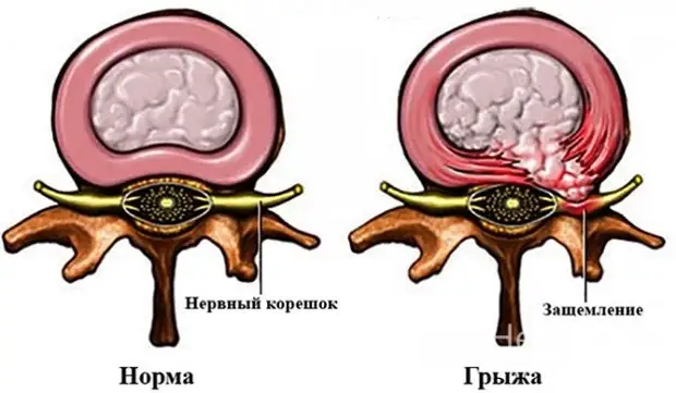 Грыжа межпозвоночного диска