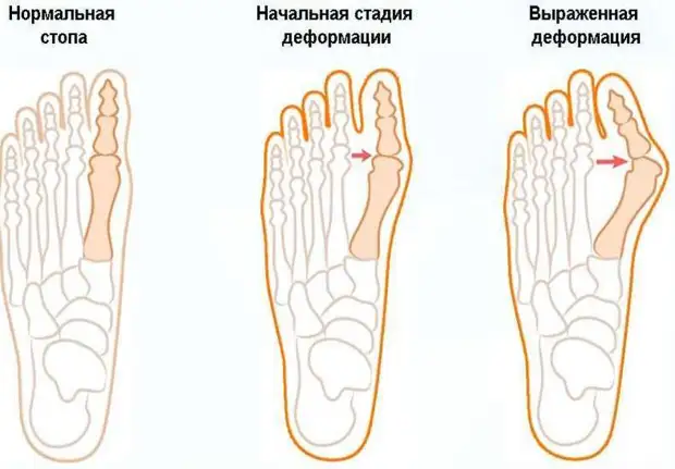 Упражнения при вальгусной деформации стопы