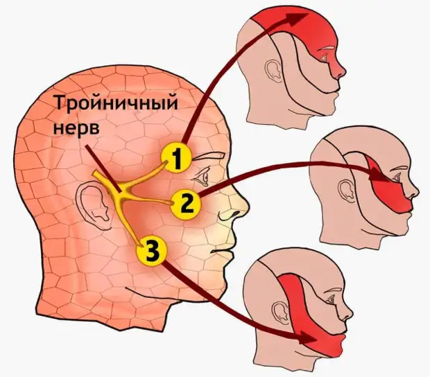 Лечение воспаления тройничного нерва