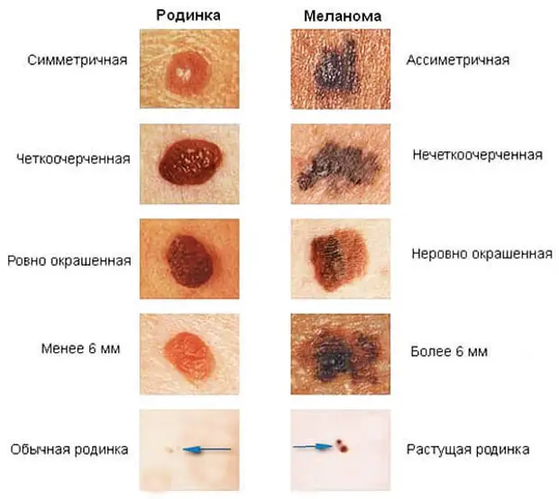 Проверьте свои родинки