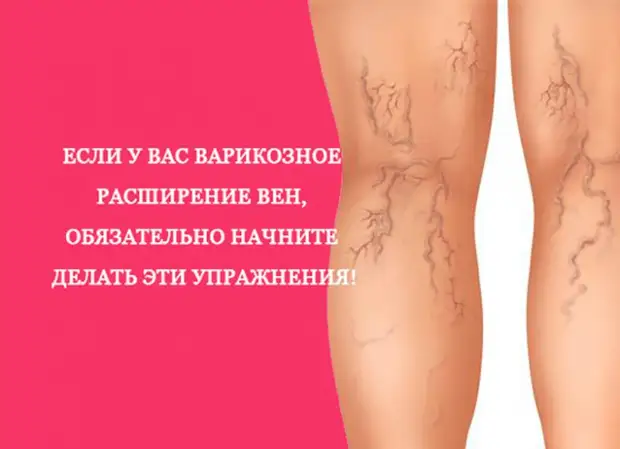Упражнения при варикозном расширении вен
