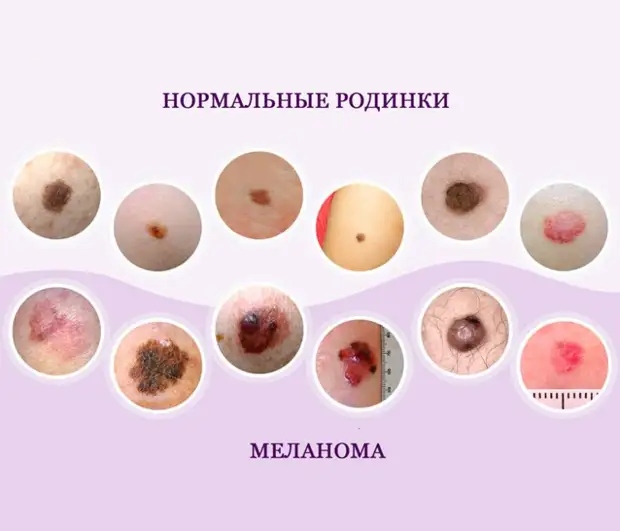 Проверьте свои родинки