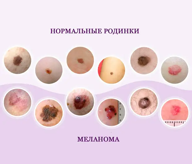 Проверьте свои родинки
